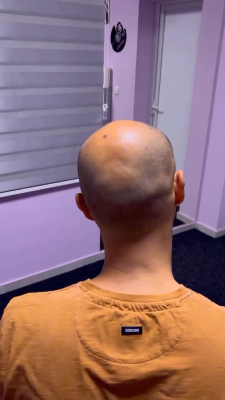 Pre tretmana: Potpuna ukočenost vrata
